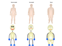 Human shapes in obesity PPT Slide