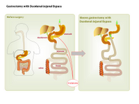 Gastrectomy with duodenal-jejunal bypass PPT Slide